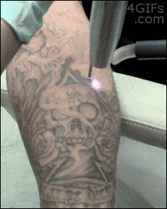 Oddly Satisfying Tattoo Removal
